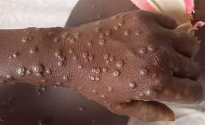 Ministério da Saúde reforça vigilância para identificar nova variante da Mpox